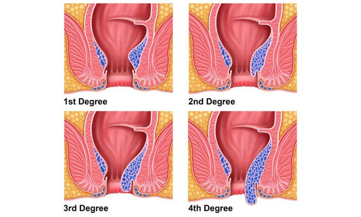 Etapas de desarrollo de hemorroides.